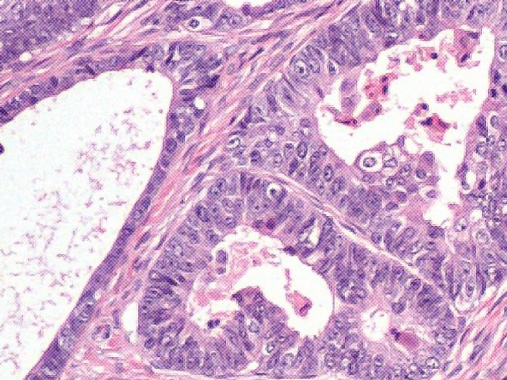 Prueban con éxito una droga que actúa como “caballo de Troya” y mata las células cancerosas
