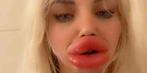 Influencer con enormes labios confiesa que ya no puede comer ni beber bien