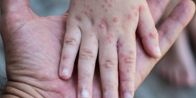 Alerta por avance del Virus Coxsackie, en el estado de Hidalgo ya están tomando medidas